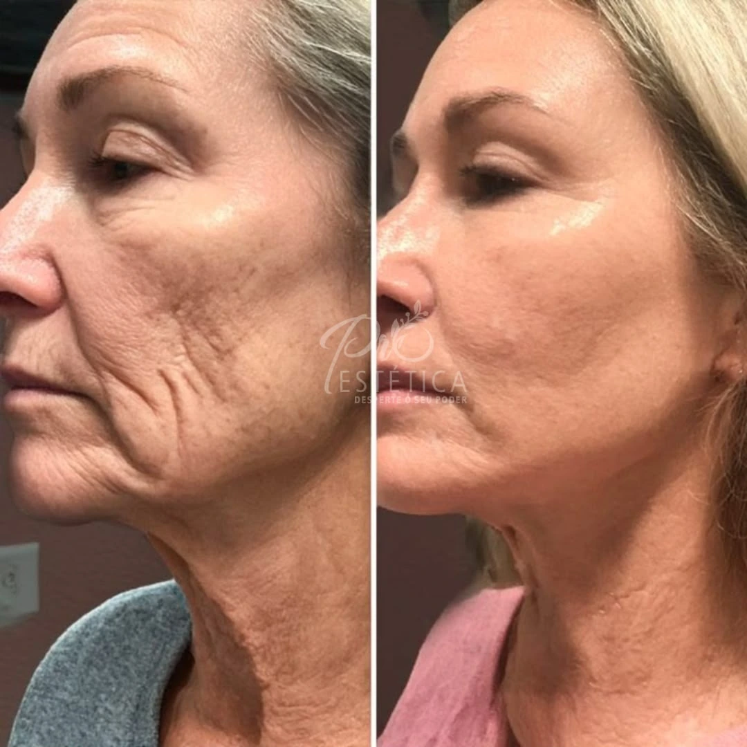 Resultado real de combo facial, comparativo de antes e depois